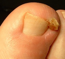 nail disease